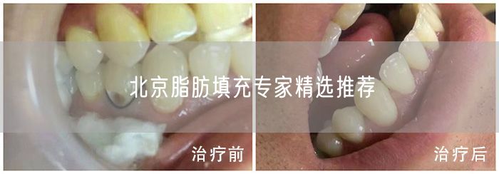 北京脂肪填充专家精选推荐