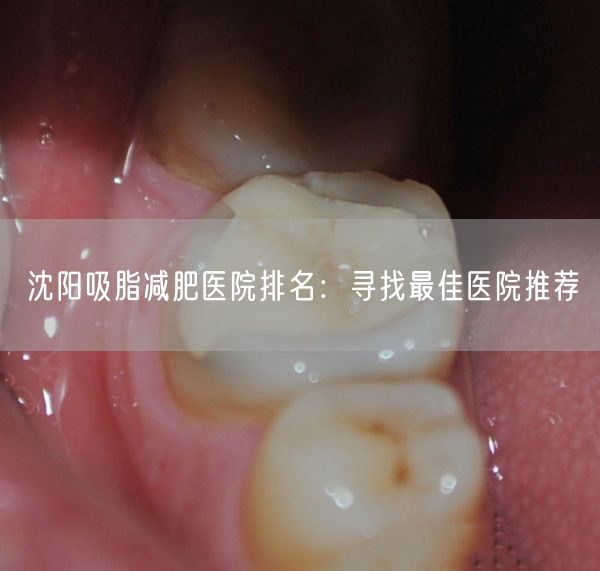 沈阳吸脂减肥医院排名：寻找最佳医院推荐