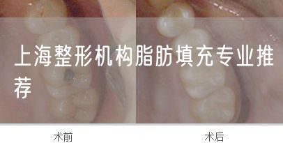 上海整形机构脂肪填充专业推荐