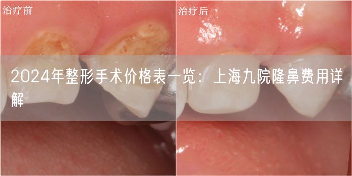 2024年整形手术价格表一览：上海九院隆鼻费用详解