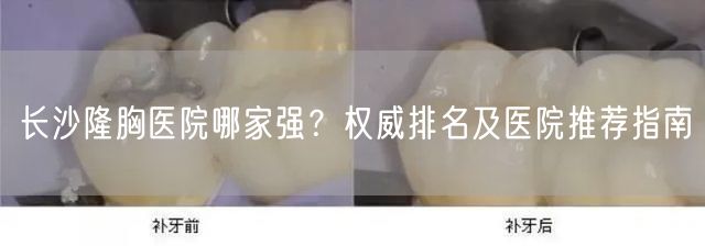 长沙隆胸医院哪家强？权威排名及医院推荐指南