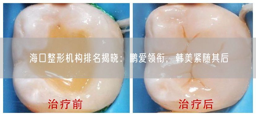 海口整形机构排名揭晓：鹏爱领衔，韩美紧随其后