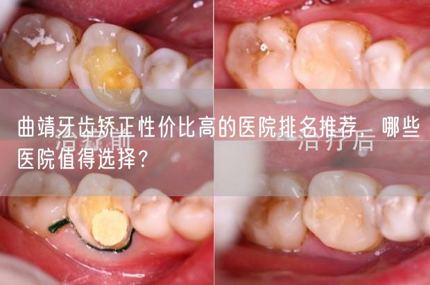 曲靖牙齿矫正性价比高的医院排名推荐，哪些医院值得选择？
