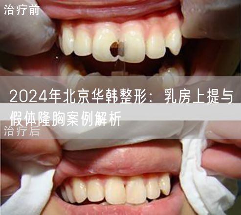 2024年北京华韩整形：乳房上提与假体隆胸案例解析
