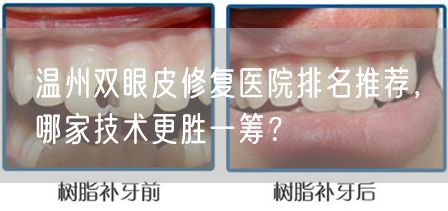 温州双眼皮修复医院排名推荐，哪家技术更胜一筹？