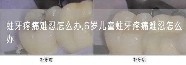 蛀牙疼痛难忍怎么办,6岁儿童蛀牙疼痛难忍怎么办