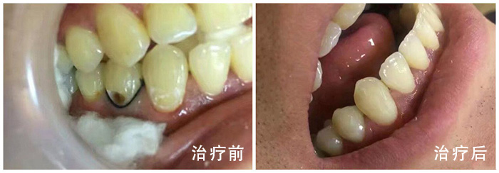 蛀牙是怎么形成的(蛀牙是怎么形成的呢)(图1)