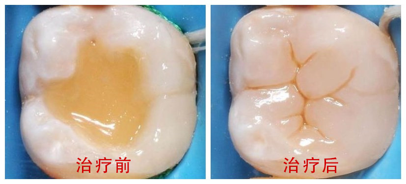 一颗牙往里歪了怎么办;一颗牙往里歪了怎么办图片(图1)