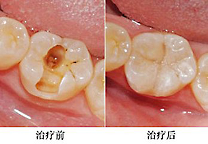 智齿牙龈发炎肿痛怎么办(图1)
