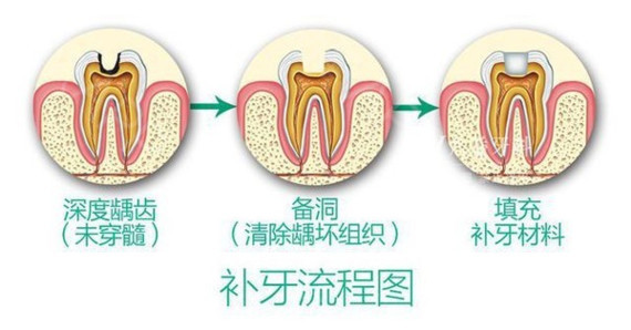 智齿痛怎么快速止痛—智齿痛怎么快速止痛最简单的办法知乎(图1)