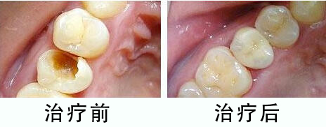 牙齿地包天怎么矫正_牙齿地包天怎么矫正方法(图1)