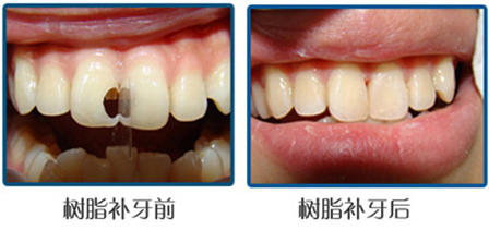 有牙结石怎么办_小孩有牙结石怎么办(图1)