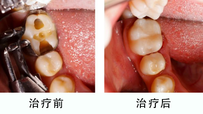 地包天怎么矫正,儿童地包天怎么矫正