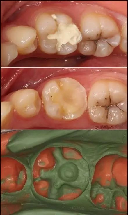 长智齿了牙龈肿痛怎么办;长智齿了牙龈肿痛怎么办缓解(图1)