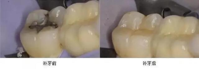 下巴后缩怎么办(下巴后缩怎么办？口腔支架)