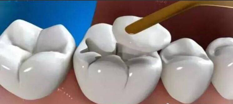 有蛀牙怎么办、有蛀牙怎么办？(图1)