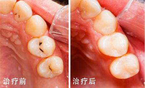 补牙之后牙疼怎么回事-补牙之后牙疼怎么回事,多久缓解(图1)