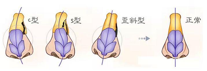 深圳鹏爱医疗整形医院做鼻修复好不好？鼻修复前后效果