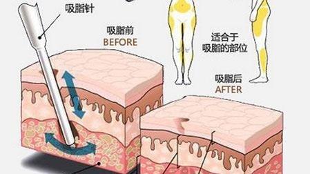 眼部为什么抽脂呢？眼部抽脂后悔的原因是什么？这里给你答案！(图1)