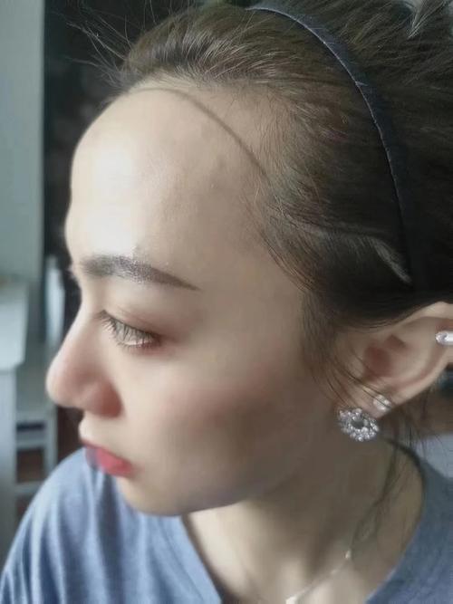 发际线植发-什么是发际线植发？效果怎么样？(图1)