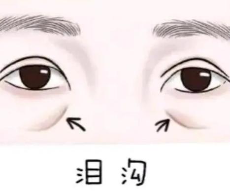 眶隔释放去眼袋填泪沟多少钱？眶隔释放祛眼袋填充泪沟的亲身感受分享给你(图1)