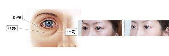 眶隔释放去眼袋填泪沟多少钱？用眶隔释方式伤害到眼球到底是真的吗？(图1)