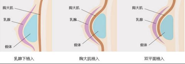 西安康美医疗整形医院怎么样？西安康美隆胸多少钱？