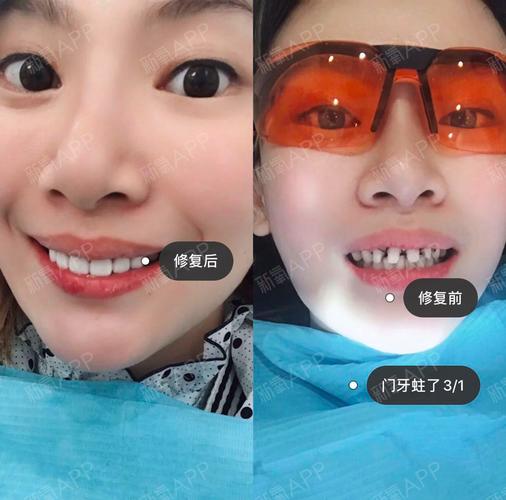 郑州全瓷牙哪里做得好_郑州欣雅美_刘冰洁医生的全瓷牙项目很受欢迎！