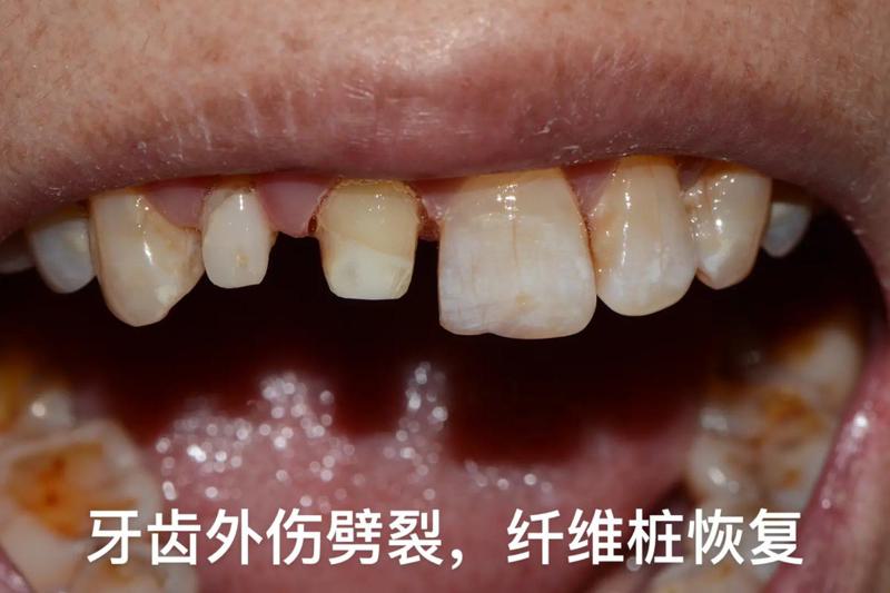 株洲中心医院补牙价格是多少？汇集医院资料和费用详情分享