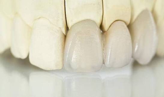 全瓷牙烤瓷牙哪个好？烤瓷牙护理方式介绍