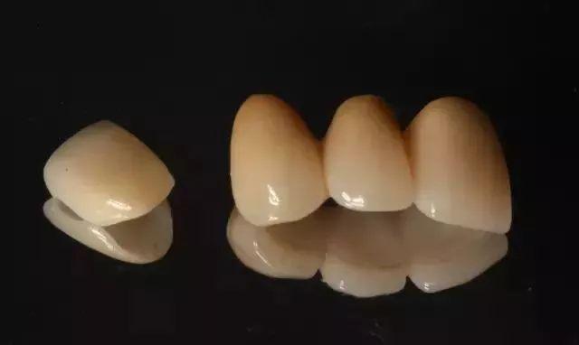 全瓷牙套价格一览：不同品牌费用多少？种植牙齿后的护理费用贵吗？(图1)