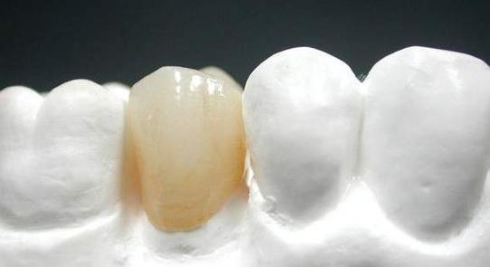 全瓷牙和烤瓷牙哪个贵？烤瓷牙与全瓷牙解析大全。