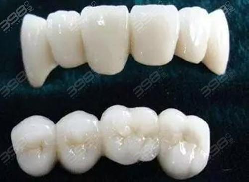 emax全瓷牙是哪个国家的？全瓷牙的耐久性较好