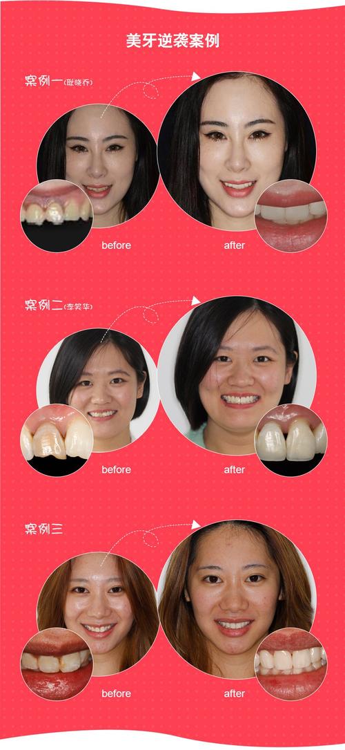 全瓷牙与烤瓷牙的费用对比：价格表一览，哪种更适合自己的需求？