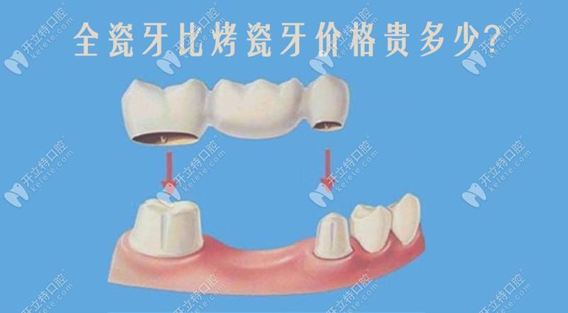 门牙做全瓷牙是否可行？医生解析全瓷牙技术怎么样与失败原因