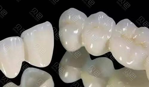 德国VITA全瓷牙价格一览：费用多少，质量如何，是否值得投资？(图1)