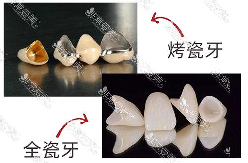 2025年最新牙冠价格一览表：烤瓷牙、全瓷牙品牌费用详解，价格贵吗？