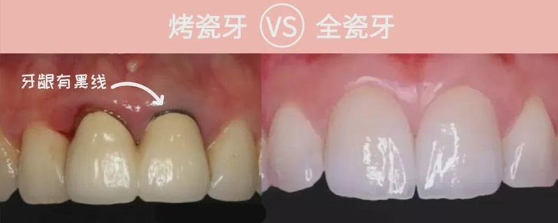 牙贴片跟全瓷牙哪个好？牙贴片护理方法要知道