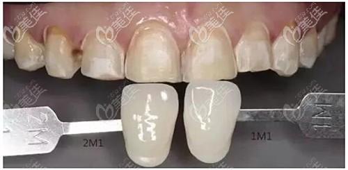 3mlava全瓷牙多少钱？哪些因素影响3mlava全瓷牙费用？3mlava全瓷牙使用多少年？