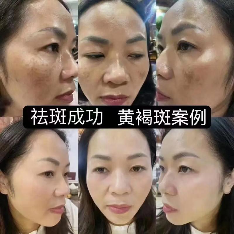 南充川北医学院美容科激光祛斑效果明显？会不会是网友骗人的？