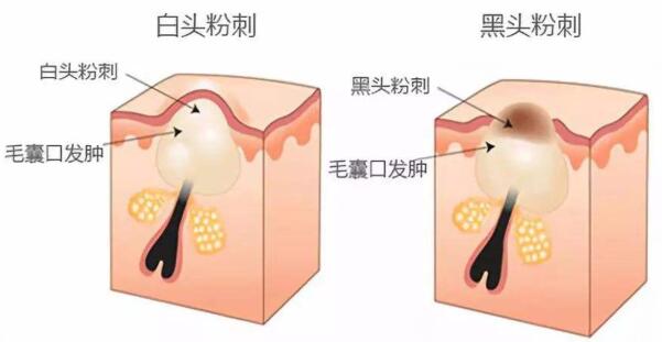 佛山颜植医疗美容祛痘怎么样？激光手术祛痘费用全解析