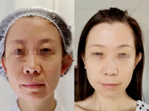 长沙美版热玛吉价格高不高？热玛吉和热拉提那个效果好一些？来看详细信息