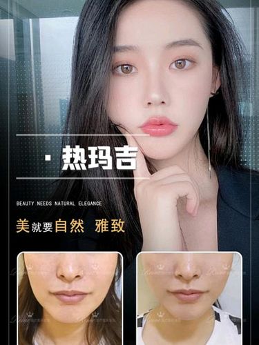成都美莱热玛吉真的假的？整友的评价看真假，不容错过！