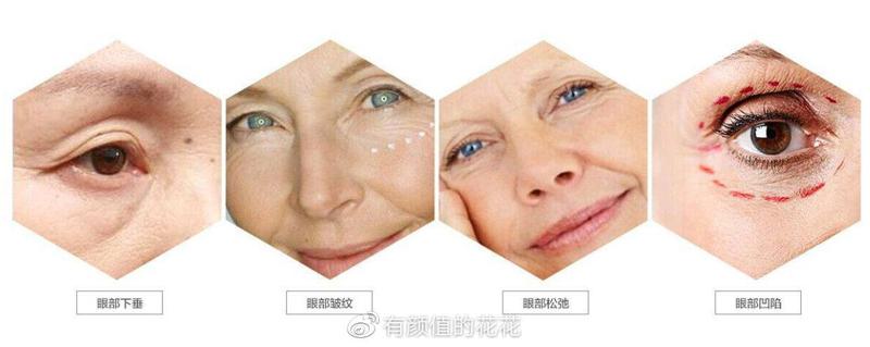 深圳哪个三甲医院可以做热玛吉？北大医院做得好不好呢？(图1)