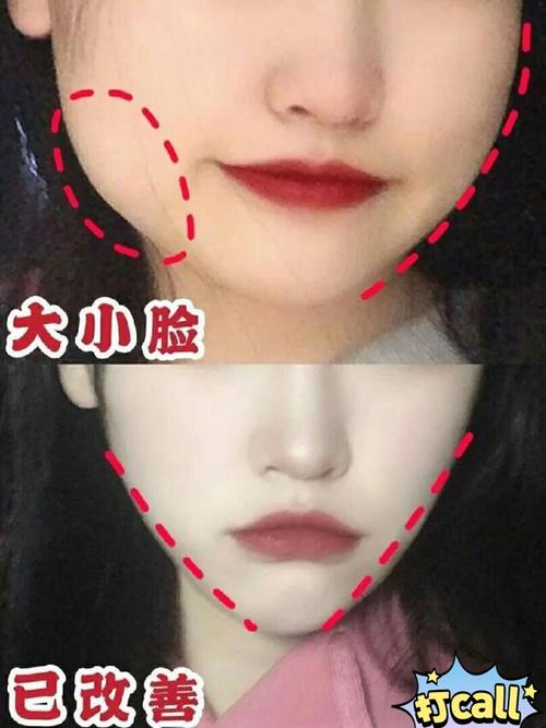 轮廓针多少钱一针呢？轮廓针的优点是什么？能维持多久呢？(图1)
