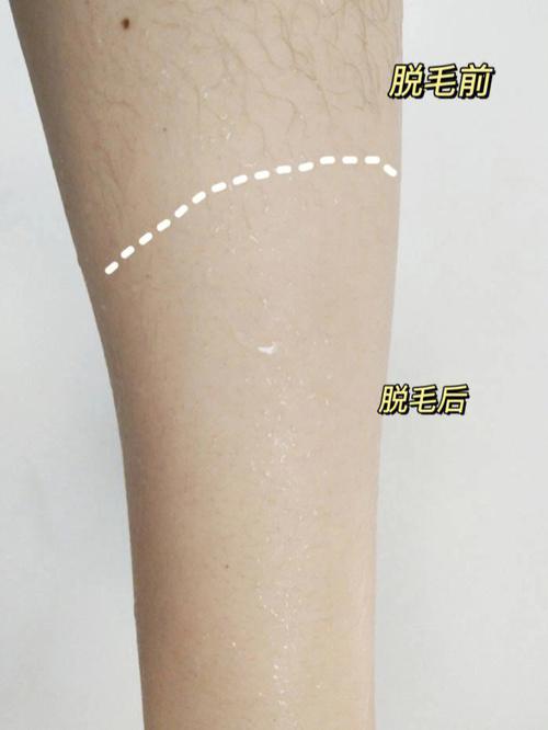 苏州美立方整形医院正规吗？地址_皮先荣医生介绍_脱毛案例
