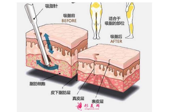 广州维密时代医疗美容怎么样？广州维密时代吸脂瘦身多少钱？