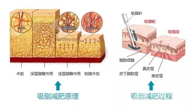 长沙凯莱美容机构如何呢？真实案例分享——告诉你手术的过程