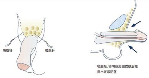 兰州三爱整形正规吗？医生技术靠谱、热门项目推荐！