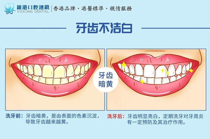 阜阳口腔医院洗牙价格表：价格表曝光，超声波洗牙与喷